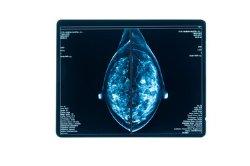 X-ray Digital Mammogram or mammography is x-ray image of the breast in women for screening Breast...