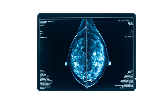 X-ray Digital Mammogram or mammography is x-ray image of the breast in women for screening Breast cancer.