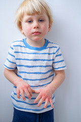 little boy with allergic rash or eczema on face and hands. severe allergic reaction, atopic skin