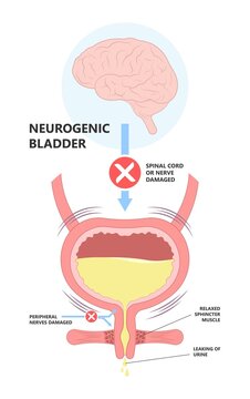 urge pass urine of pelvic floor muscle frequently Bed wetting toilet urination older nerve brain spasm tract tumor cancer stroke stress atonic Benign Lower Often leak anuria Neural Cystitis cord
