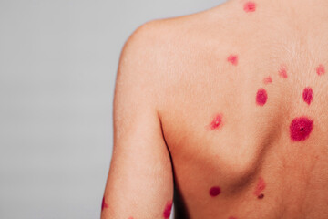 Naklejka premium The back is in red dots. The concept of chickenpox. Smear pimples from chickenpox with a cotton bud. Place for text. Treatment of ulcers from chickenpox, varicella with medical cream on the kid skin