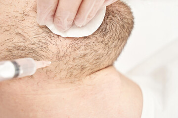 Injection at spa salon. Doctor hands in gloves. Closeup. Pretty male patient. Beauty treatment....