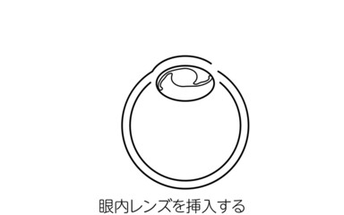 白内障手術の流れ、図解イラスト（線画）、眼内レンズを挿入する