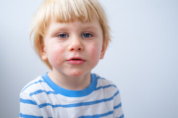 portrait of little boy with allergic rash or eczema on face. severe allergic reaction, atopic skin