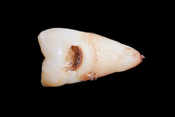 Close up of the broken wisdom tooth in isolated black background