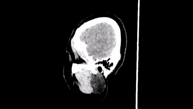 sagittal  ct scan  of right sphenoid wing meningioma
