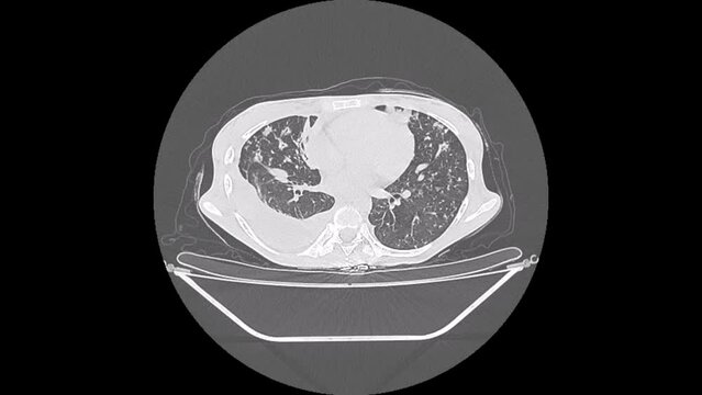 miliary tuberculosis, chest ct scan
