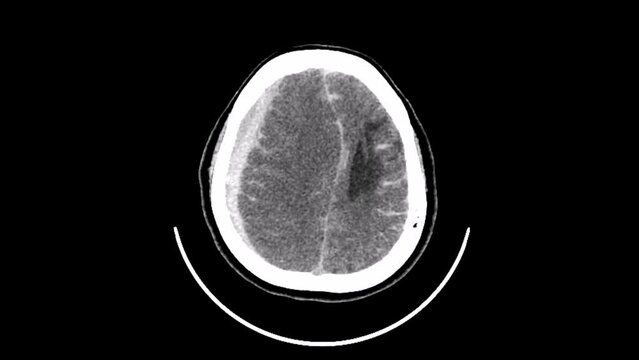 bleeding stroke axial ct scan
