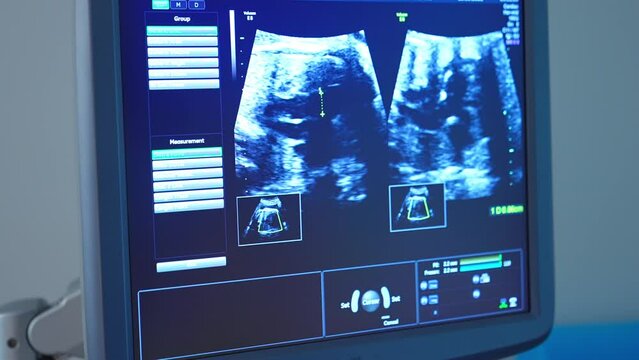 Screen of 3d ultrasound check of pregnancy in clinic. Equipment for ultrasonar scan. Maternity and Healthcare concept.