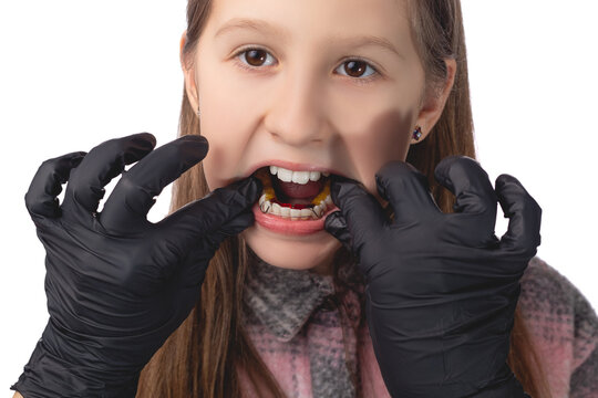 A doctor in black medical gloves tries on an orthodontic appliance for a little girl. The concept of teeth alignment in childhood. Studio photo on a white background.