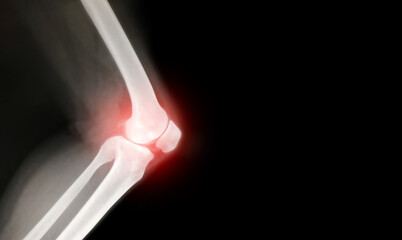 knee bone inflammation computer x-ray images