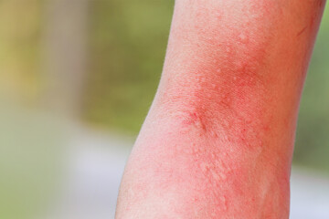 close up skin allergy itching on arm skin body allergic a caterpillar sting or insect bites dermatitis,Health care concept. - obrazy, fototapety, plakaty