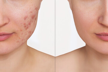 Cropped shot of young woman's face before and after acne treatment isolated on white background....