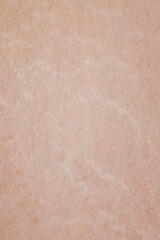 Fototapeta premium Stretch marks on human skin
