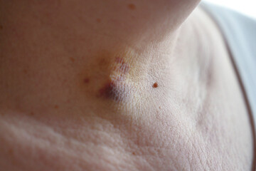 bruises on the neck of a woman as a consequence of laser removal of a benign tumor of the thyroid gland