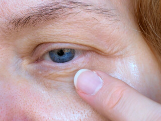 middle aged female's eye with drooping eyelid. Ptosis is a drooping of the upper eyelid, lazy eye. Cosmetology and facial concept, woman using cream cosmetic from first wrinkles