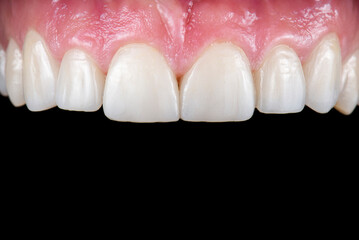 dental macro photography, ceramic crowns and veneers