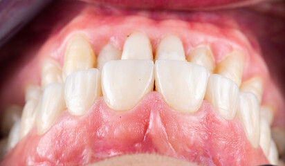 dental macro photography, ceramic crowns and veneers