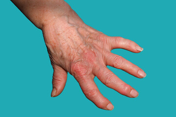 An Old Woman's Hand, Deformed From Rheumatoid Arthritis, highlighted on a blue background. - obrazy, fototapety, plakaty