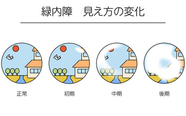 緑内障の図解、緑内障の進行による視野の変化、メディカルイラスト