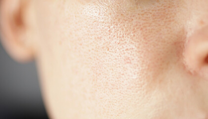 Skin texture, unhealthy with with enlarged pores and rosacea, red rashes. Allergic and redness....