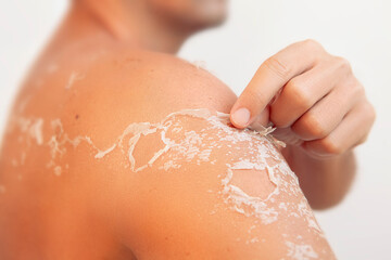 Peeling skin at man back and shoulder from sunburn, flaking skin and skincare concept	
