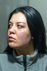 Caucasian woman with allergic reaction. Problematic face skin. Symptoms of allergic reaction. Acne...