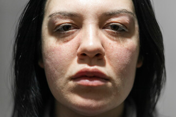 Caucasian woman with allergic reaction. Problematic face skin. Symptoms of allergic reaction. Acne problems. Close up photo. - obrazy, fototapety, plakaty