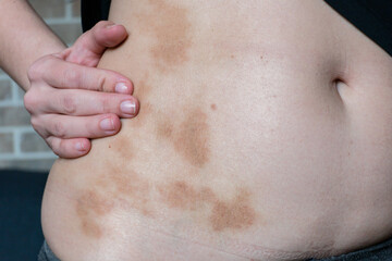 Large spots on the skin of a woman's body