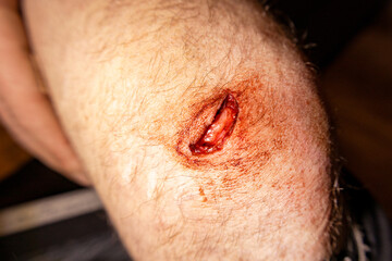 Open wound on knee. Blood comes from a wound on the leg, close-up, cut leg