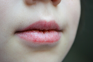 Dry and damaged lips of a girl. Close-up. Lip fissure and bleeding. Sick cracked damaged tissue....