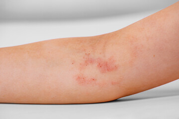 atopic dermatitis on the child's arm - obrazy, fototapety, plakaty