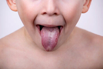 white plaque and bald spots on the tongue close-up