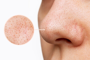 Close up of female nose with blackheads or black dots and magnifying glass with an enlarged image...