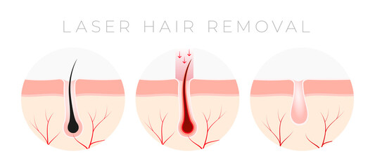 IPL Laser hair removal verctor illustration concept