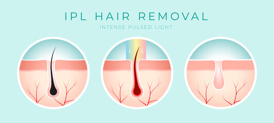 IPL Laser hair removal verctor illustration concept