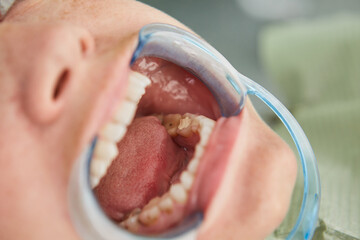 Patient with cheek retractor in mouth receiving dental treatment.