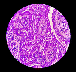 Endometrial (Uterine) cancer awareness: Photomicrograph of uterine biopsy showing Endometrial cancer or Endometrial carcinoma.