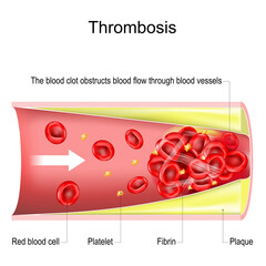 thrombosis. The blood clot obstructs blood flow through blood vessels