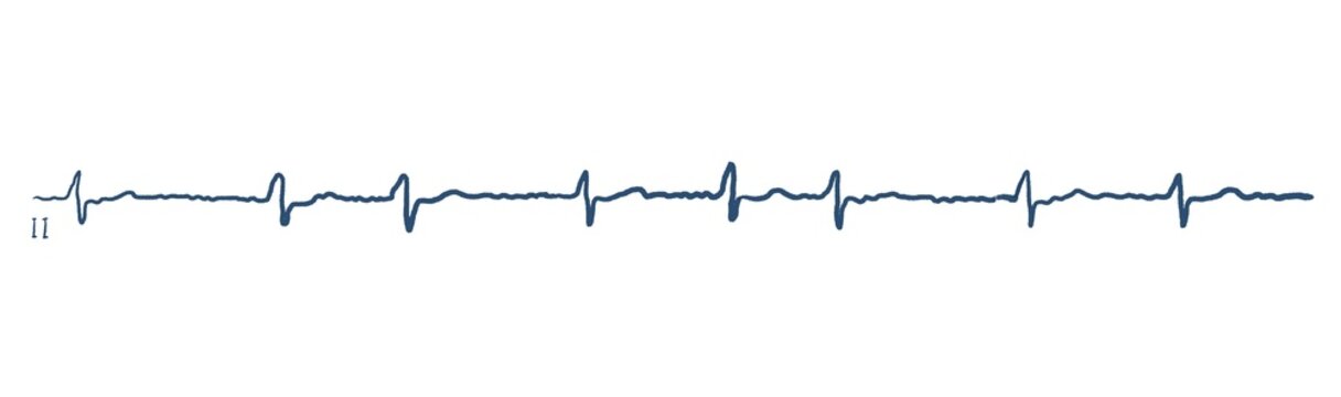 ECG Image Show Atrial Fibrillation, Vector Illustration