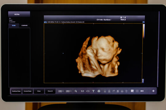 Picture 4D with Ultrasound of baby in mother's womb show the face.