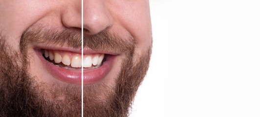 Dental care and whitening teeth compare, man before and after whitening isolated on white...