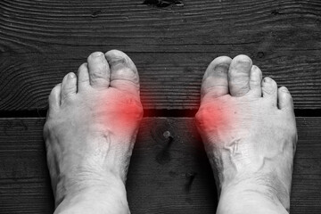Legs of an elderly woman on the floor with red spots where there are places of pain on the floor,...