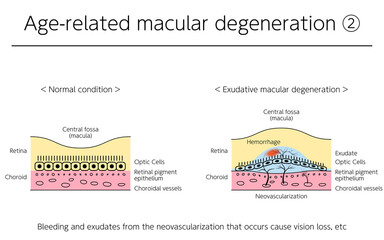 眼病、滲出型加齢黄斑変性症の図解