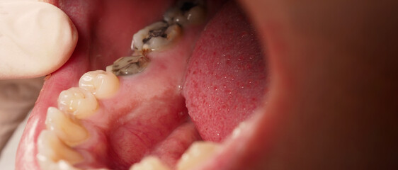 Decayed tooth root canal treatment. Tooth or teeth decay of lower molar. Restoration with a composite filling. Adult caries. bad teeth. Dental temporary restorative material. Dental concept. close up. © gnepphoto