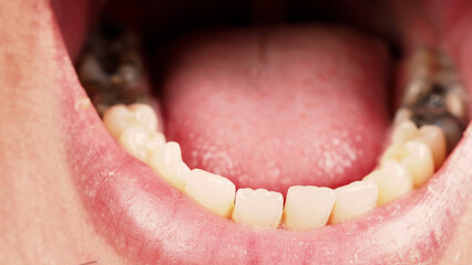 Decayed tooth root canal treatment. Tooth or teeth decay of lower molar. Restoration with a...