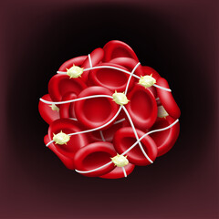 Blood clots block the flow of blood. Red blood cells, platelets and fibrin.