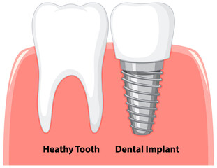 Heathy tooth and dental implant in gum on white background