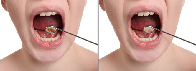 Collage with photos of woman before and after professional treatment of dental plaque on white...
