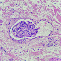 Camera photo of breast carcinoma with lymphovascular invasion, magnification 400x, photograph...